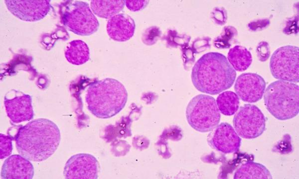 روش تشخیص سرطان خون,اخبار پزشکی,خبرهای پزشکی,تازه های پزشکی