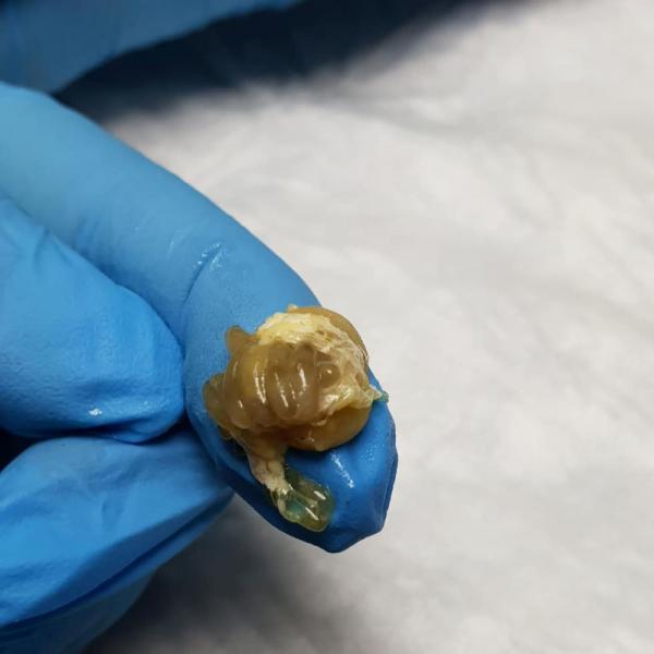 زایمان سوسک با عمل جراحی,اخبار جالب,خبرهای جالب,خواندنی ها و دیدنی ها