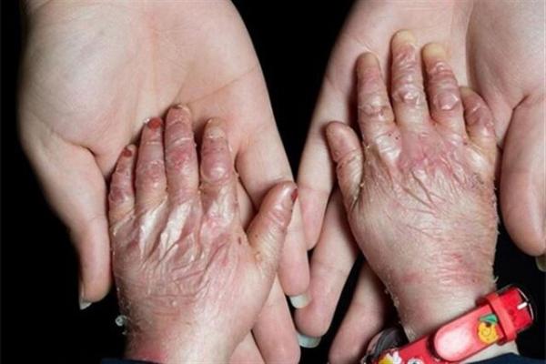 بیماران پروانه‌ای‌ها,اخبار پزشکی,خبرهای پزشکی,بهداشت