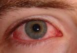 عفونت های ویروسی چشمی,اخبار پزشکی,خبرهای پزشکی,بهداشت