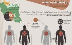 اینفوگرافی پلاسما درمانی