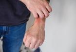 خارش بدن,اخبار پزشکی,خبرهای پزشکی,تازه های پزشکی