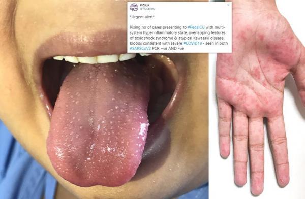 علائم مرتبط با کرونا در کودکان علائم مرتبط با کرونا در کودکان,اخبار پزشکی,خبرهای پزشکی,بهداشت