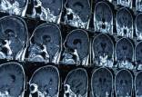 تعیین میزان آسیب‌های مغزی با هوش مصنوعی,اخبار پزشکی,خبرهای پزشکی,تازه های پزشکی