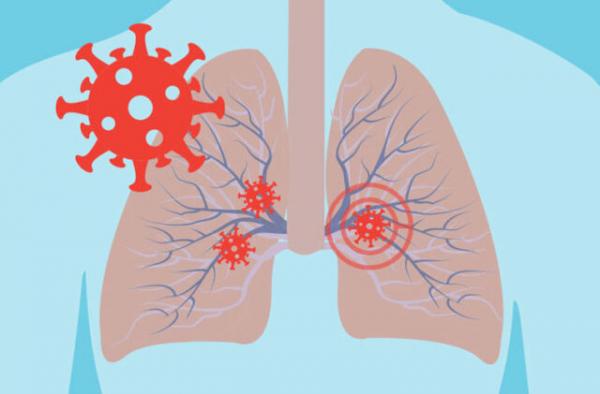 ارتباط نارساییِ تنفسی ناشی از کرونا با گروه‌ خونی,اخبار پزشکی,خبرهای پزشکی,تازه های پزشکی