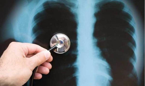 ارتباط نارساییِ تنفسی ناشی از کرونا با گروه‌ خونی,اخبار پزشکی,خبرهای پزشکی,تازه های پزشکی