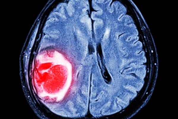 درمان سرطان مغز با داروی ضدمالاریا,اخبار پزشکی,خبرهای پزشکی,تازه های پزشکی
