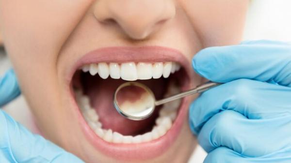 نقش بهداشت دهان و دندان بر تشدید بیماری التهاب روده,اخبار پزشکی,خبرهای پزشکی,تازه های پزشکی