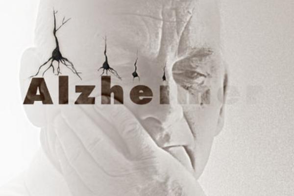 تشخیص زودهنگام آلزایمر,اخبار پزشکی,خبرهای پزشکی,تازه های پزشکی