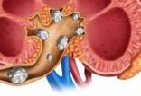 از بین بردن سنگ کلیه با امواج فراصوت ملایم,اخبار پزشکی,خبرهای پزشکی,تازه های پزشکی