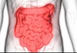 بیماری التهاب روده,اخبار پزشکی,خبرهای پزشکی,تازه های پزشکی