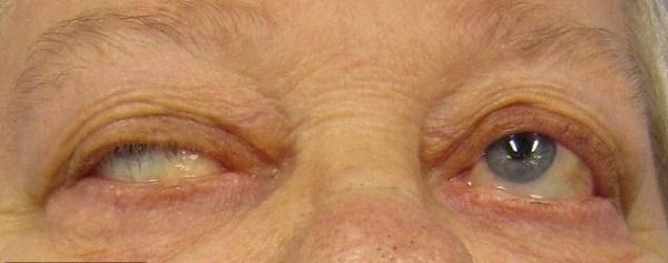 علامت عجیب و نادر در بیماران کرونایی,اخبار پزشکی,خبرهای پزشکی,تازه های پزشکی