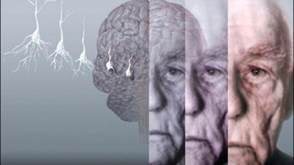 تشخیص آلزایمر از روی حرف زدن,اخبار پزشکی,خبرهای پزشکی,تازه های پزشکی