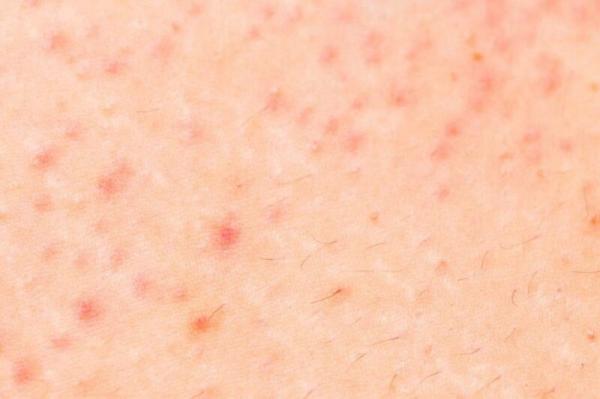 کرونا ویروس,اخبار پزشکی,خبرهای پزشکی,تازه های پزشکی