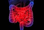 بررسی بیماری التهابی روده با کمک یک ابزار پوشیدنی,اخبار پزشکی,خبرهای پزشکی,تازه های پزشکی