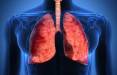عامل آسیب به ریه در اثر ابتلا به کرونا,اخبار پزشکی,خبرهای پزشکی,تازه های پزشکی