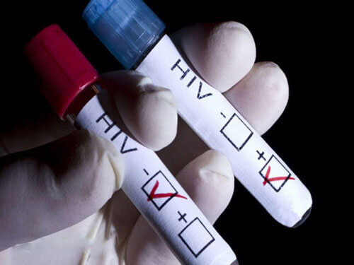 نشانه‌های یدز,اچ آی وی,علائم ایدز