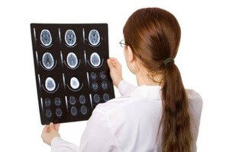 سکته مغزی,تشخیص سکته مغزی,درمان سکته مغزی
