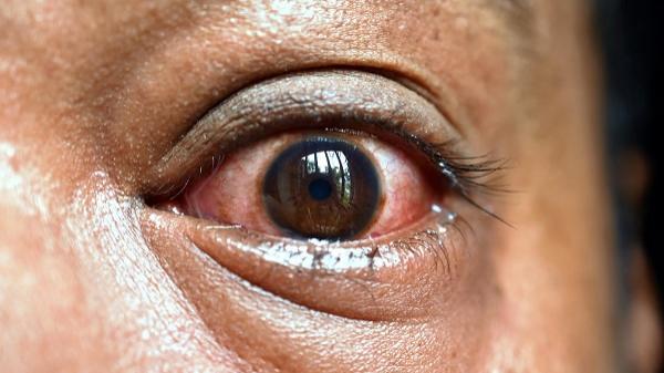 عوارض چشمی در عفونت ویروس قارچ سیاه