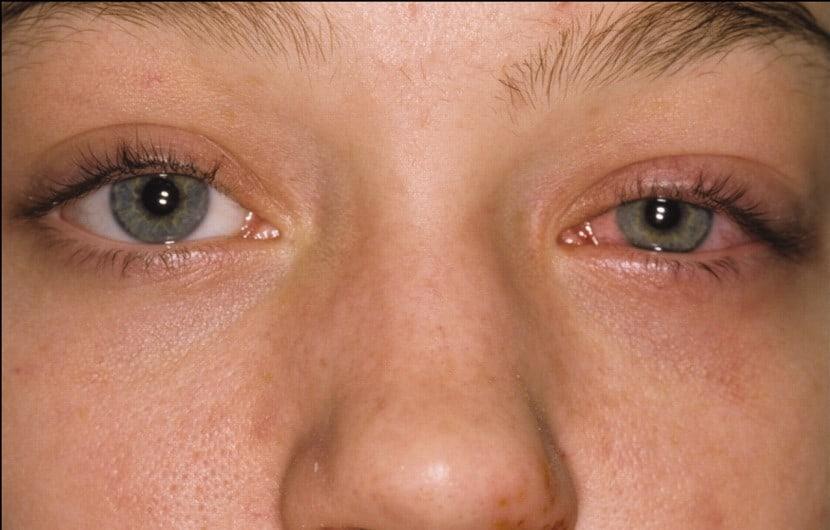بلفاریت,التهاب پلک چشم,بیماری های چشمی