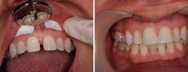 از بین بردن فاصله دندان با ماده باندینگ,کامپوزیت برای پر کردن فاصله دندان ها,علت فاصله بین دندانها