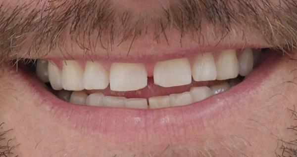 پر کردن فاصله دندان,روش های بستن فاصله بین دندانی,فاصله دندان