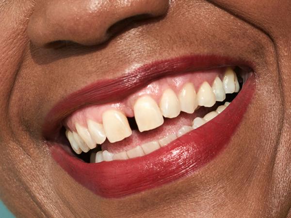 بستن فاصله دندان,هزینه بستن فاصله بین دندان ها,درمان فاصله بین دندان ها