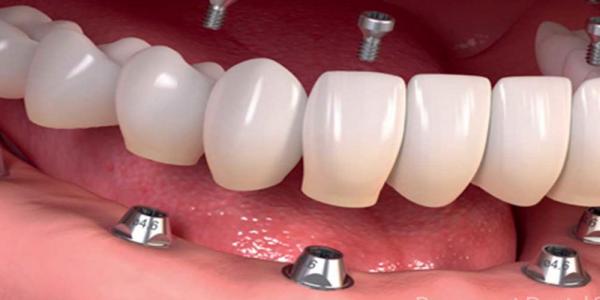 مقایسه انواع ایمپلنت دندان