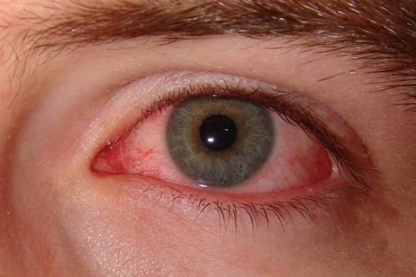 التهاب‌ ملتحمه‌,التهاب پلک‌ چشم,سفیدی چشم