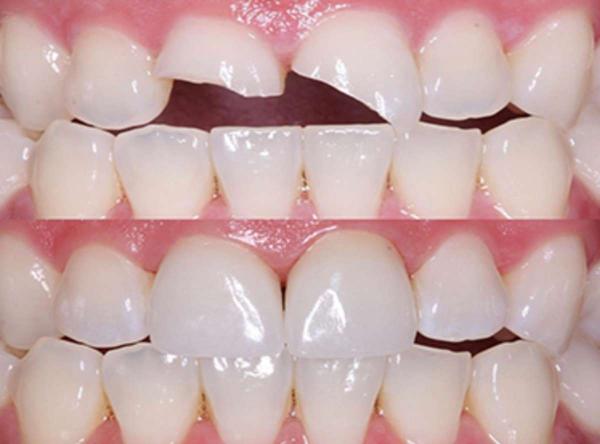 پیوند دندان,باندینگ دندان,مراحل پیوند دندان