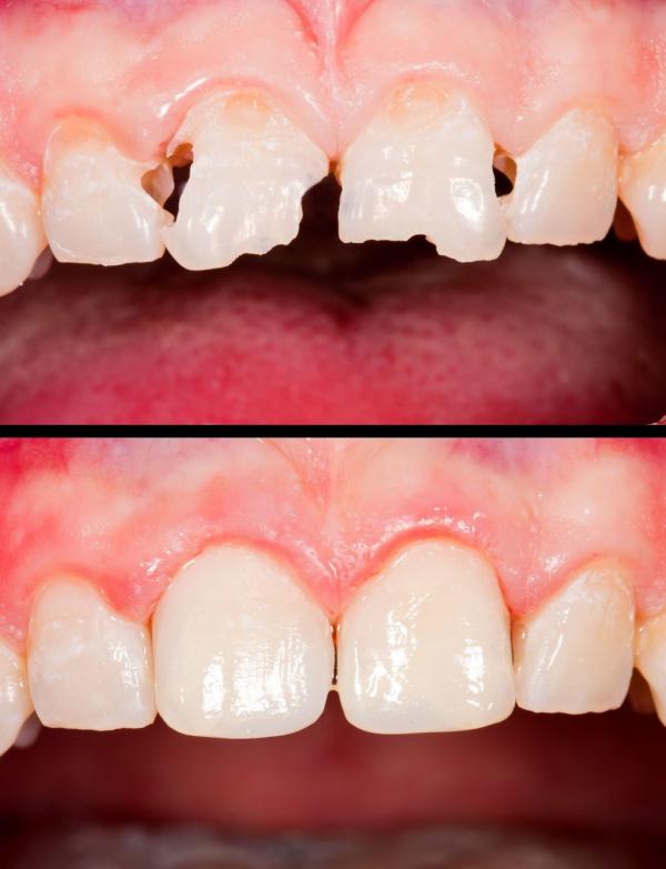 پیوند دندان,باندینگ دندان,روش درمان از طریق باندینگ دندان