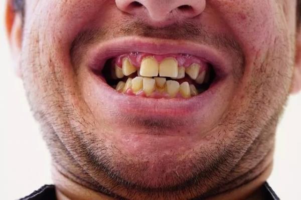 کراودینگ دندان,کراودینگ دندانی چیست,همه چیز درباره کراودینگ دندانی