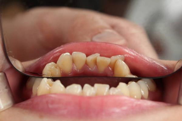 کراودینگ دندان,کراودینگ دندانی چیست,انواع کراودینگ دندانی