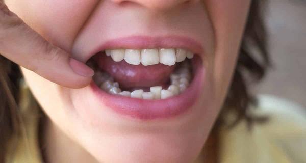 کراودینگ دندان,کراودینگ دندانی چیست,درمان کراودینگ به چه عواملی بستگی دارد