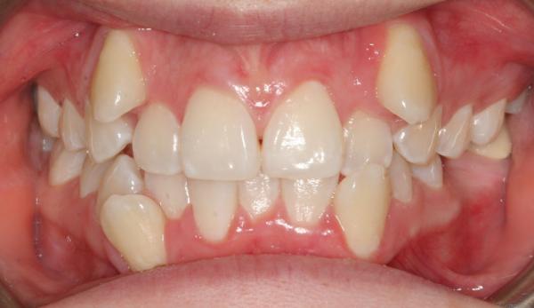 کراودینگ دندان,کراودینگ دندانی چیست,عوامل تاثیرگذار برای درمان کراودینگ دندانی