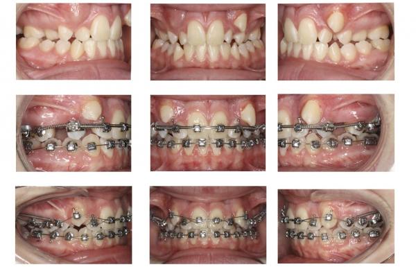 کراودینگ دندان,کراودینگ دندانی چیست, درمان کراودینگ دندانی با ارتودنسی