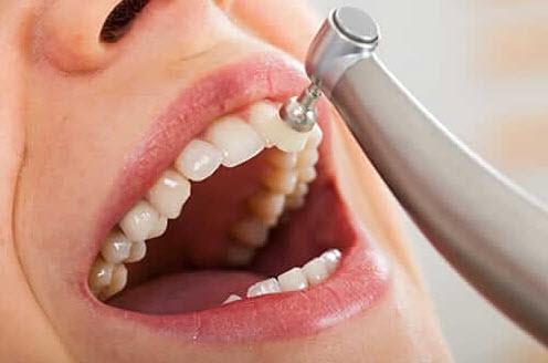 کاربرد مینا کاری دندان,علت از بین رفتن مینای دندان,میناکاری دندان چیست