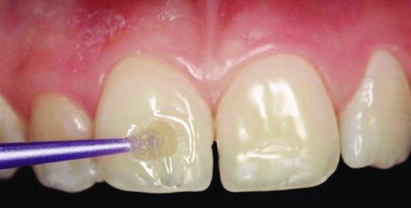راه های مراقبت از مینای دندان,علائم فرسایش مینای دندان,علت خرابی مینای دندان