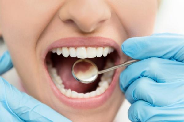 روشهای میناکاری دندان,علت خرابی مینای دندان,مینا کاری دندان برای پیشگیری از پوسیدگی دندان