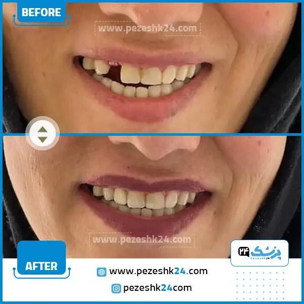 قبل و بعد ایملپنت دندان