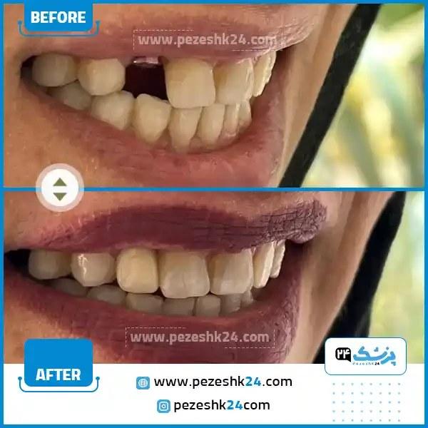 قبل و بعد کاشت ایمپلنت دندان تهران