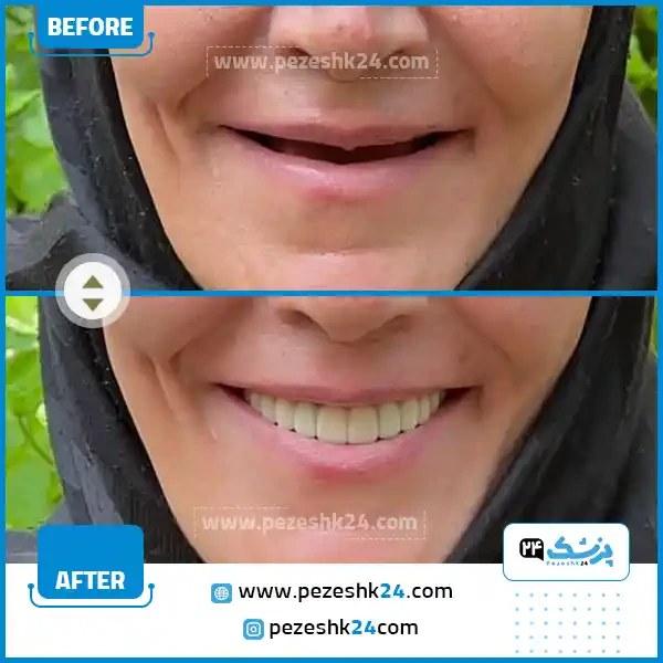 قبل و بعد کاشت دندان تهران