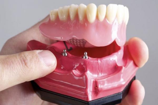 عوارض دندان مصنوعی بیشتر است یا اوردنچر؟ عوارض دندان مصنوعی بیشتر است یا اوردنچر؟