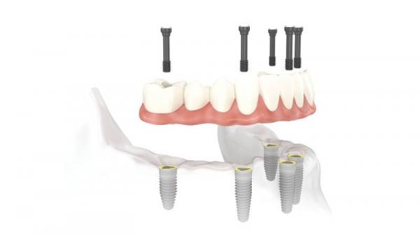 اوردنچر دندان اوردنچر دندان