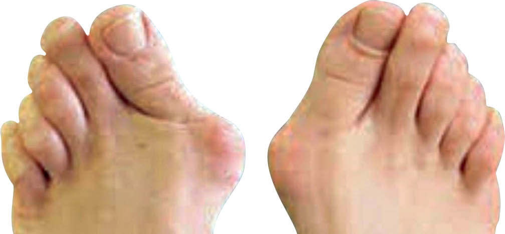 بیماری هالوکس والگوس,ضافی کف پا,درمان انحراف انگشت شست