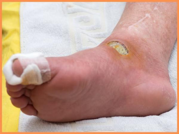 زخم دیابت از کجا شروع میشود؟ زخم دیابت از کجا شروع میشود؟