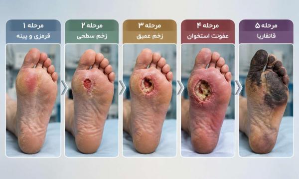 مراحل ۵ گانه پیشرفت زخم دیابت از قرمزی تا قانقاریا مراحل ۵ گانه پیشرفت زخم دیابت از قرمزی تا قانقاریا