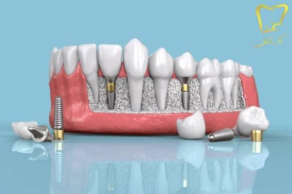 مزایای ایمپلنت دیجیتال در کرج