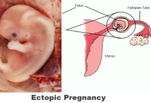 نشانه های بارداری خارج از رحم,تشخیص حاملگی خارج از رحم,بارداری خارج از رحم