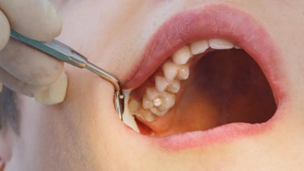پرکردن دندان,هزینه پرکردن دندان,پر کردن دندان با مواد همرنگ کامپوزیتی